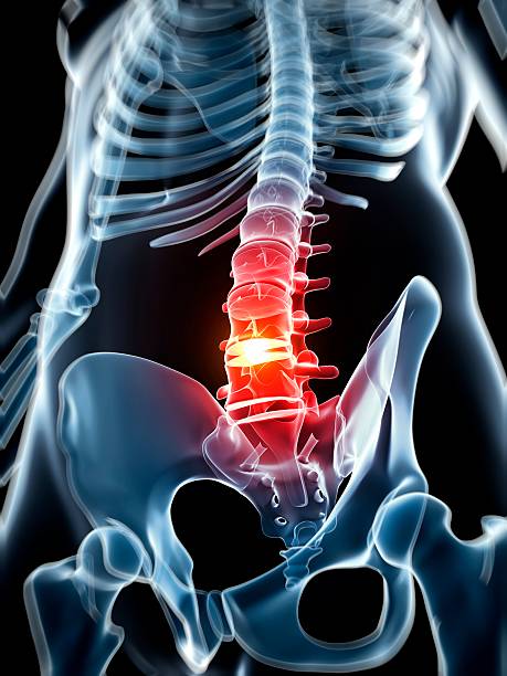 Dores Lombares: Estratégias de Fisioterapia que Promovem Alívio Imediato e Duradouro